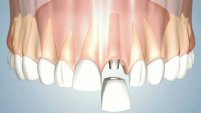 Ripristino di uno o più denti con impianti osteointegrati