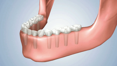 Ripristino di tutti i denti con impianti osteointegrati