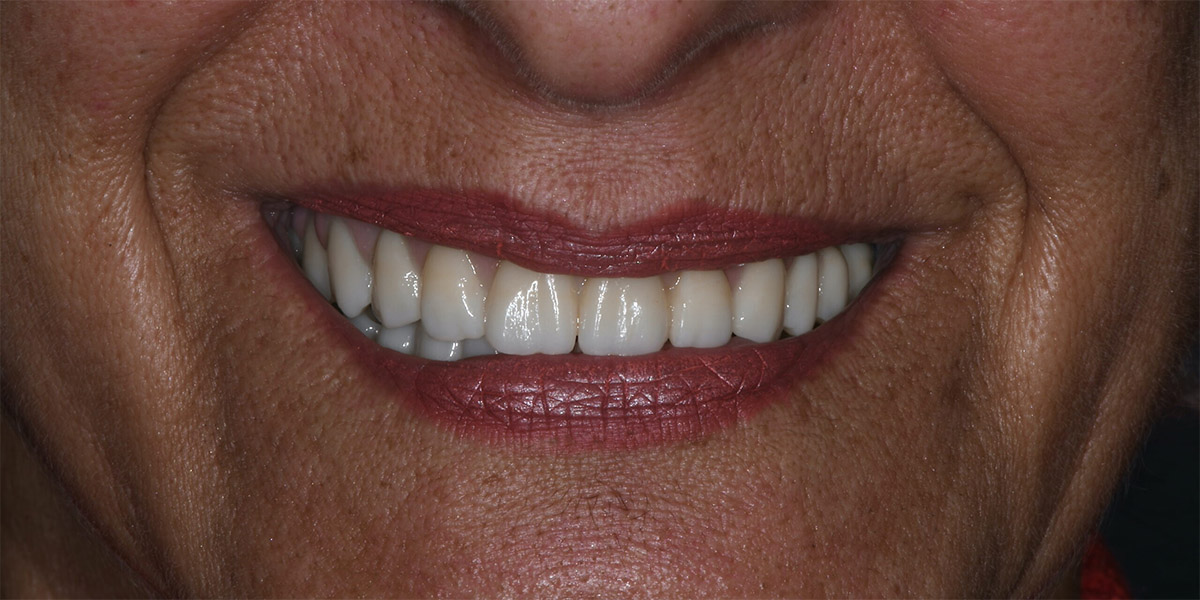 Tornare a masticare e sorridere con denti fissi